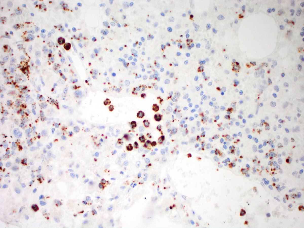 Atypical lymphoid cells staining for TIA-1 (Immunoperoxidase, 200x)